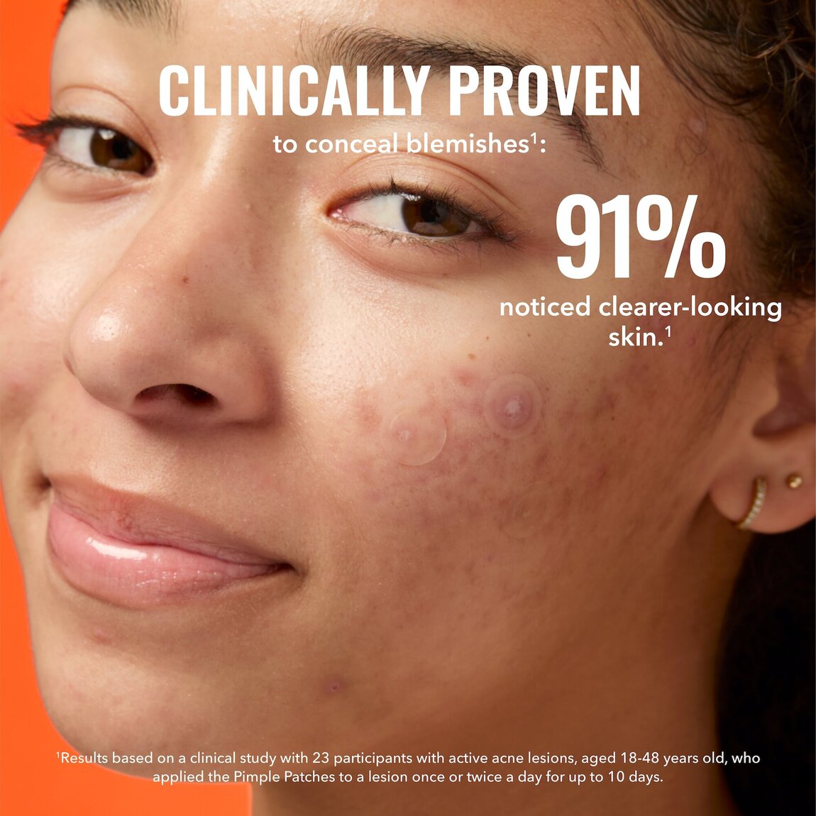 pimple-patches-h6 zb_p.jpg