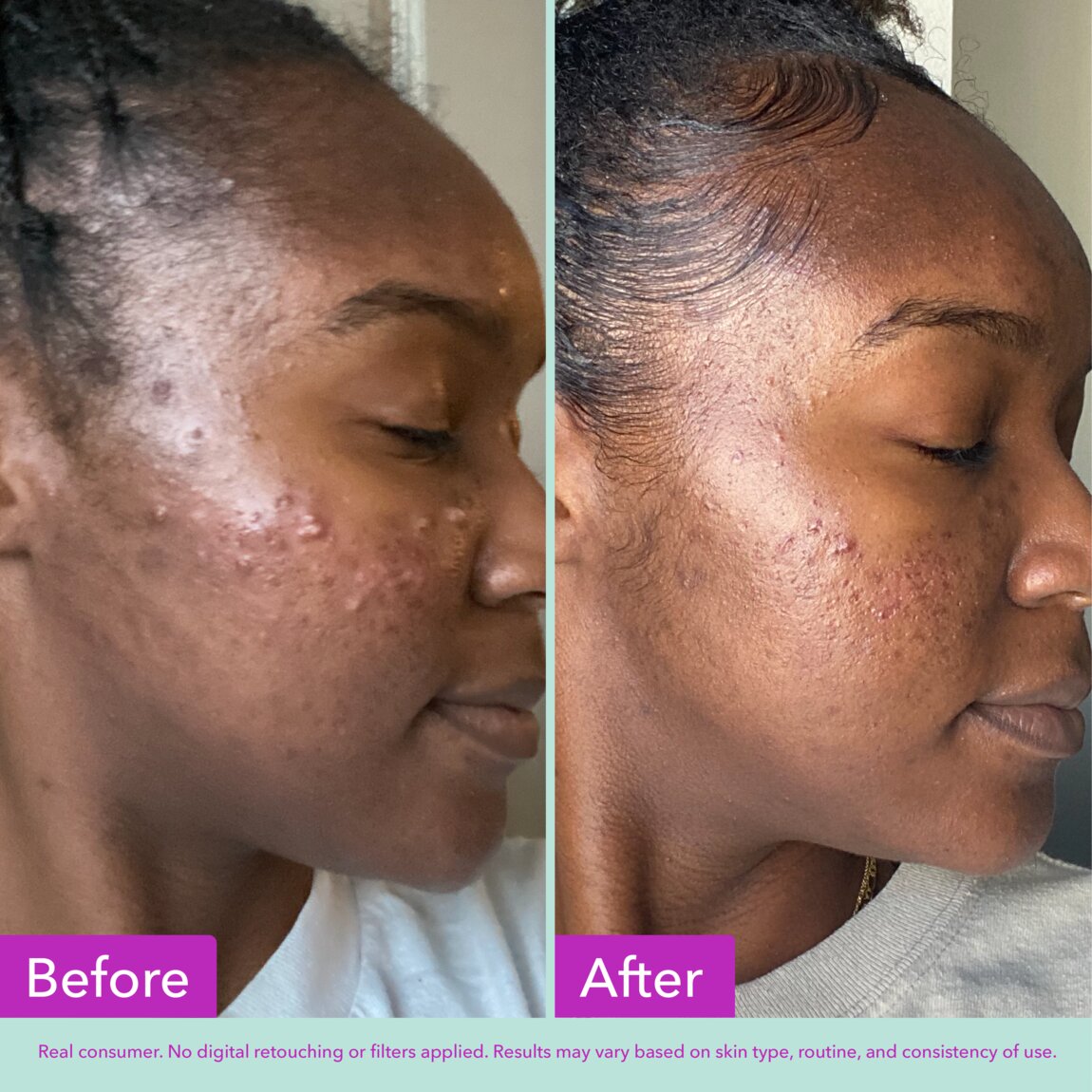 acne-foaming-cleanser-d0 zb_p.jpg